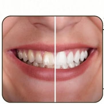 Radiance Package ✨ at Teeth Whitening Lounge in Santa Ana, CA